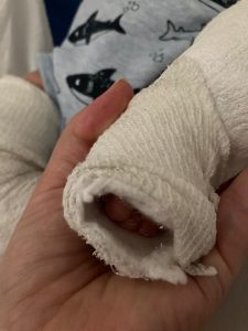 The plaster cast has completely peeled off