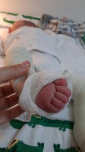 Swelling of the foot (cast incorrectly placed in another location)