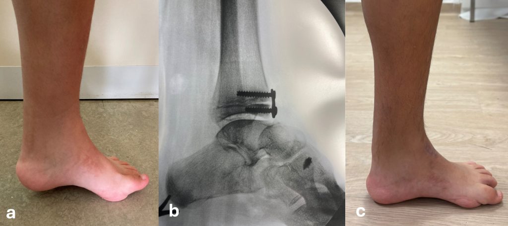 Clubfoot already subjected to repeated tenotomy of the Achilles tendon: persisting equinus deformity and cavus (a). Radiographic control after anterior epiphysiodesis of the distal tibia (b) associated with other procedures. Clinical picture after 1 year (c)