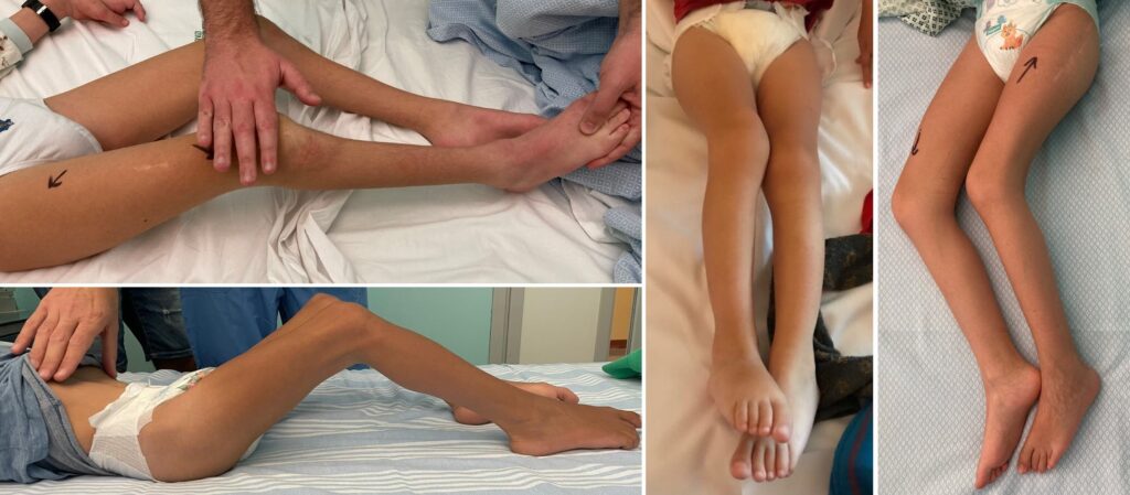 Fibrotomia multipla: indicazioni. Esempi tipici di pazienti candidati 