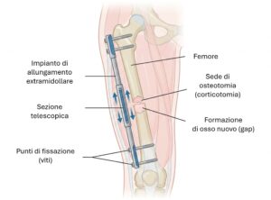 Allungamento extramidollare: schema esemplificativo