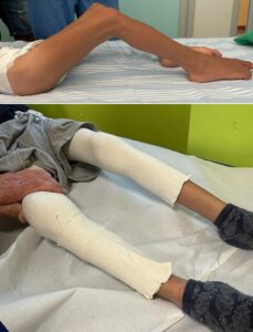 Fibrotomia multipla: quadro clinico degli arti inferiori prima e dopo la procedura