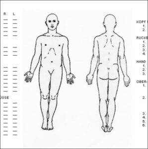 Fibrotomia multipla: scheda di pianificazione che veniva utilizzata in passato per decidere le sedi da trattare