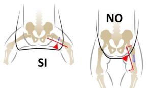 Posizione che favorisce lo sviluppo delle anche (dal sito International Hip Dysplasia Institute)