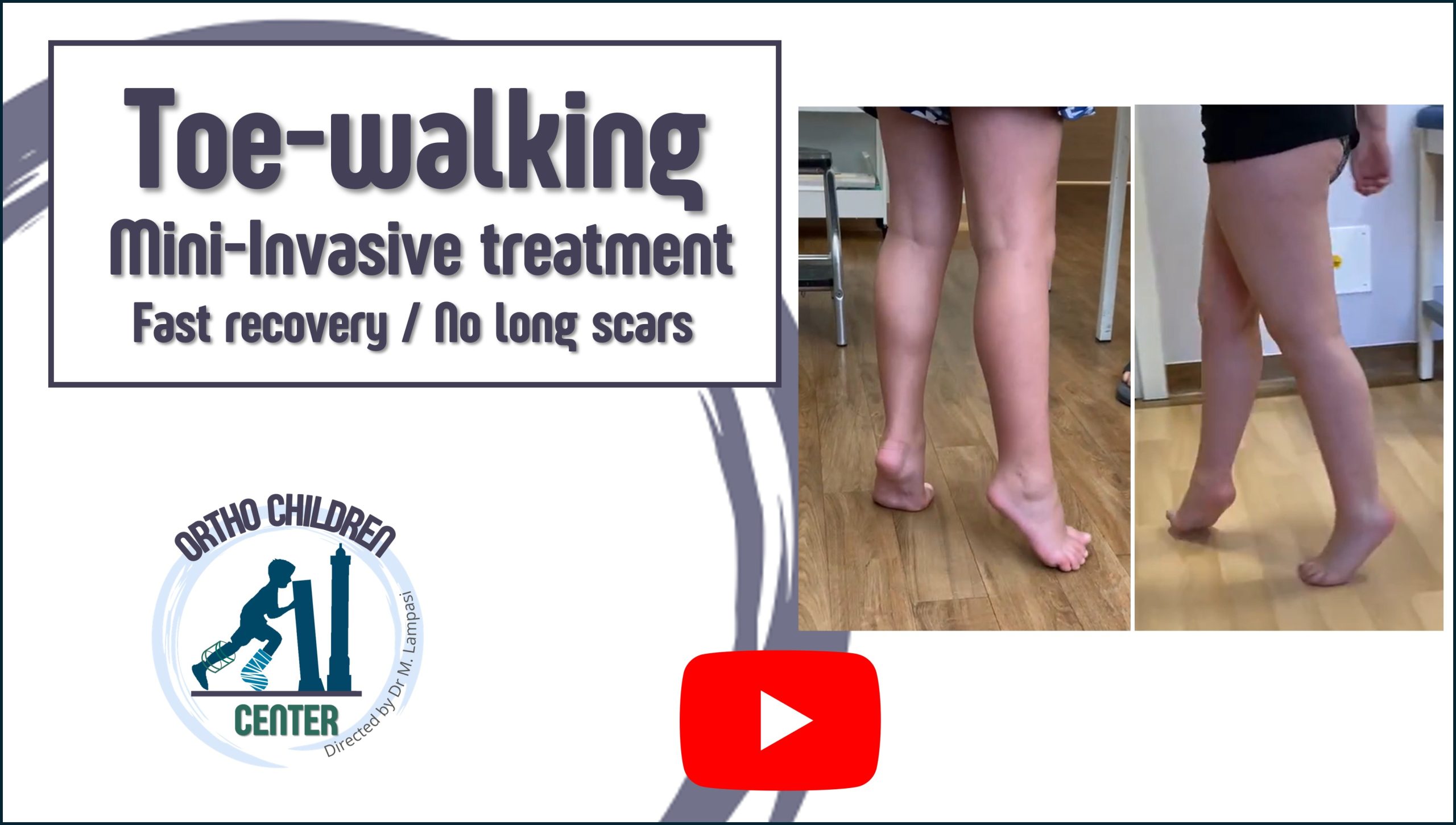 Nuovo video: “Toe walking: intervento mini-invasivo”