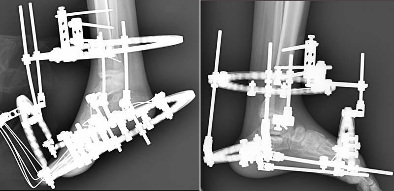 Esempi di costrutti di fissatori esterni secondo la metodica di Ilizarov applicati ai piedi nel nostro Centro