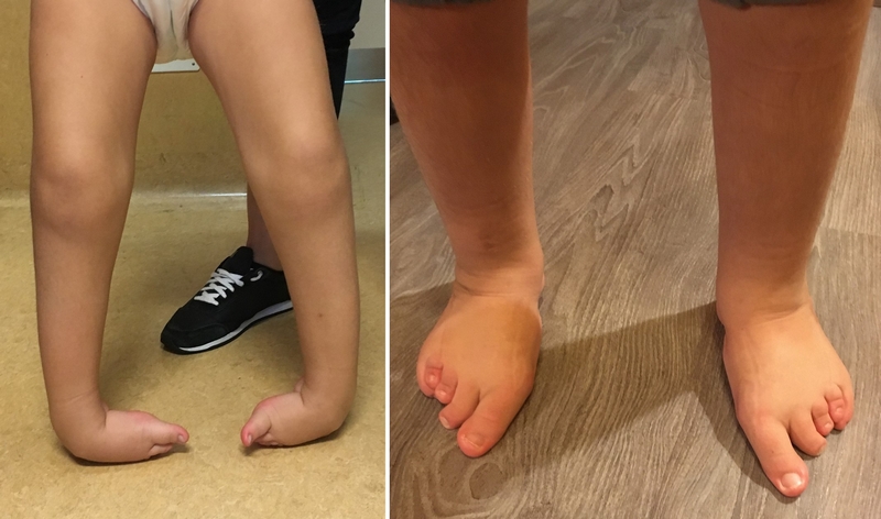 Grave deformità dei piedi in quadro sindromico. Buon risultato dopo intervento correttivo (eseguito dal dr Lampasi)
