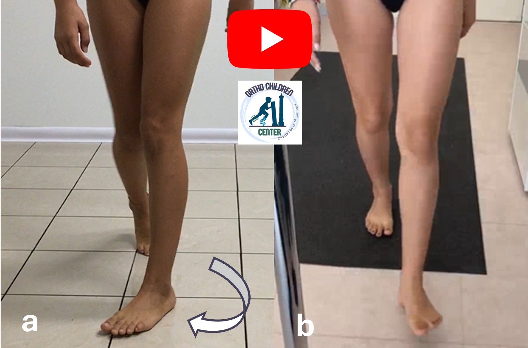 Internal Rotation (severe femoral anteversion): minimally invasive surgery