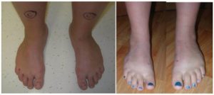 Metatarso varo prima (a) e dopo (b) trattamento chirurgico (doppia osteotomia)