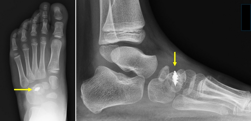 Aspetto radiografico della vite-ancora, che appare completamente inglobata nell’osso