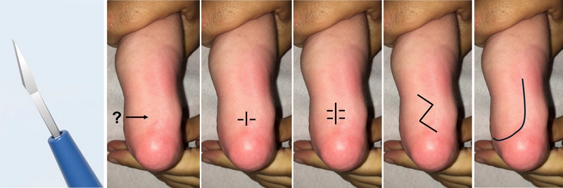 Sulla sinistra un microbisturi e la cicatrice che rimane dopo una tenotomia con microbisturi. Sulla destra, simulazioni di cicatrici che possono derivare da tecniche più invasive