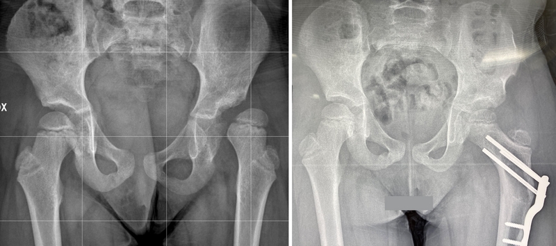 Bimba di 6 anni (già sottoposta a numerosi interventi in altre sedi). Quadro radiografico dopo osteotomia di Salter e osteotomia di femore (dr Lampasi)
