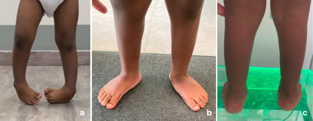 Bimbo di 3 anni con grave recidiva (a). Trattato nel nostro centro con tecniche mini-invasive (b,c): le cicatrici sono appena percepibili