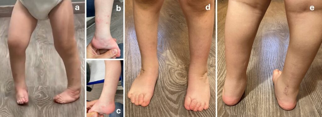 Bimba di 2 anni e mezzo (a) già operata in altro centro con tecnica chirurgica classica e lunga cicatrice dal polpaccio al piede su tutte e due i lati (b,c) rapidamente recidivata. Buona correzione dopo trattamento con tecniche mini-invasive percutanee nel nostro centro (d,e)