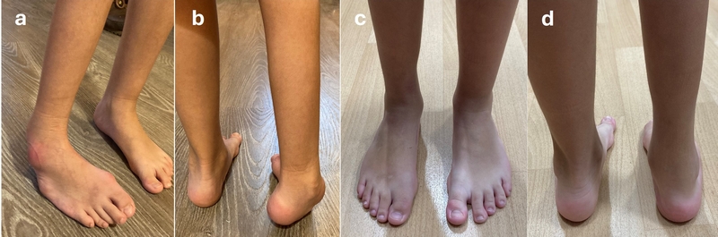 Piede torto neurogeno destro: prima (a,b) e dopo (c,d) intervento correttivo (eseguito dal dr Lampasi)