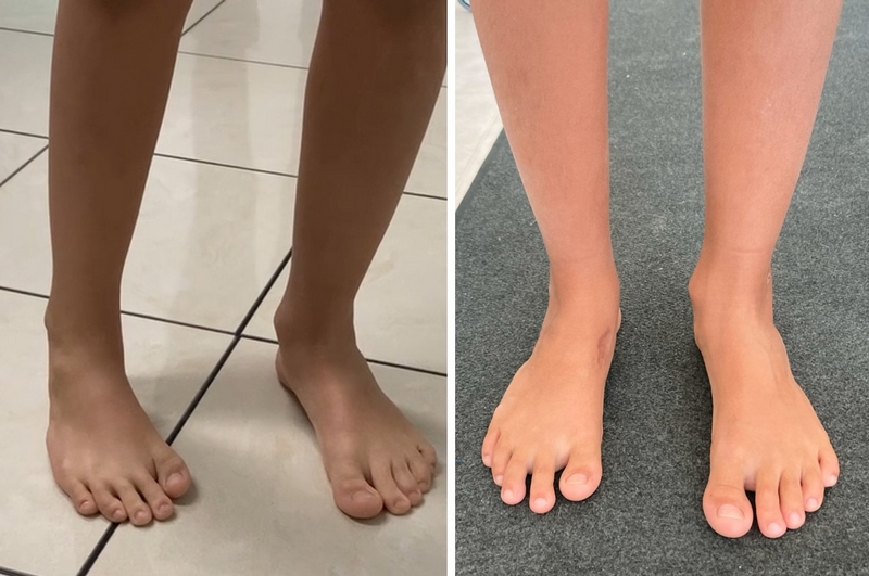 Piede destro recidiva di piede torto. Buona correzione dopo intervento di transfer