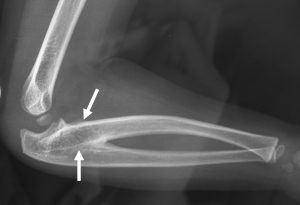 Congenital radioulnar synostosis