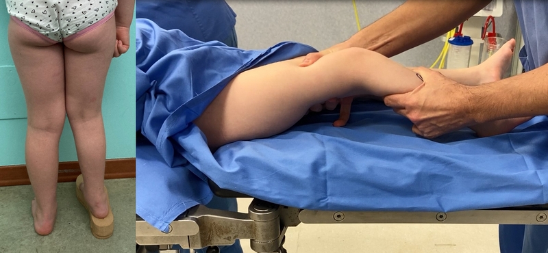 Bimba di 4 anni affetta da ipoplasia dell’arto inferiore destro (è presente rialzo sotto il piede). Valutazione clinica della stabilità del ginocchio. Viene quindi programmata SUPERKnee e successivo allungamento dell’arto