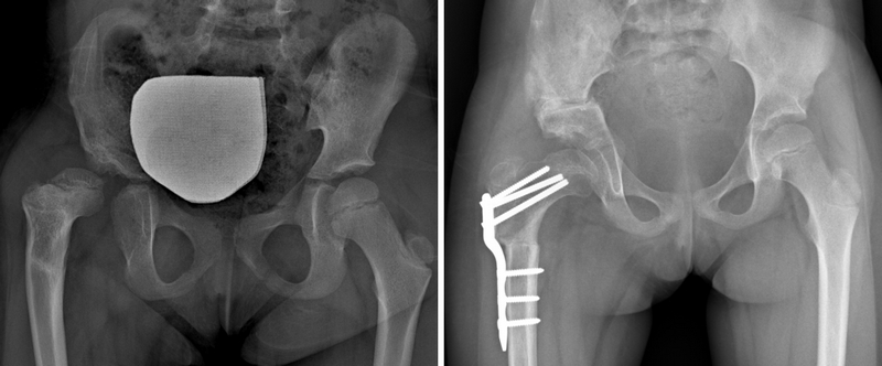 Bimba di 3 anni con lussazione dell’anca destra non trattata: quadro radiografico dopo intervento di riduzione cruenta, tettoplastica e osteotomia del femore (eseguito dal dr Lampasi)