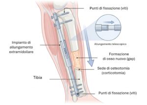 Allungamento extramidollare: schema