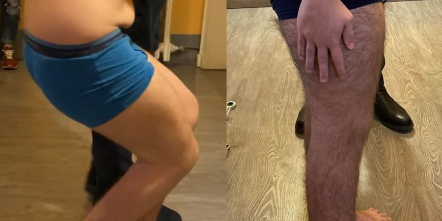 Crouch gait nella Paralisi Cerebrale Infantile: intervento multi-level (14 anni)