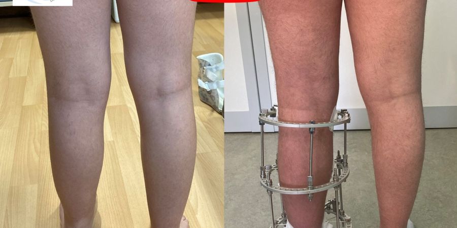 Posteromedial Tibial Bowing: Limb lengthening and deformity correction (OrthoChildren Center)