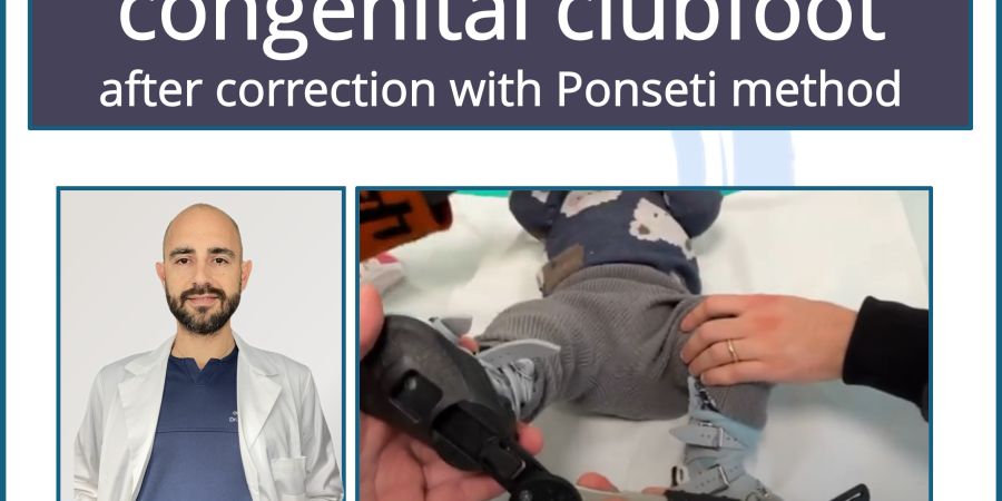 New tutorial: Manipulations for clubfoot after correction with the Ponseti method (Dr. M. Lampasi)