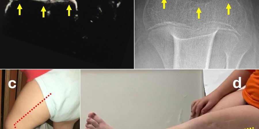 Congenital patellar dislocation: a difficult diagnosis