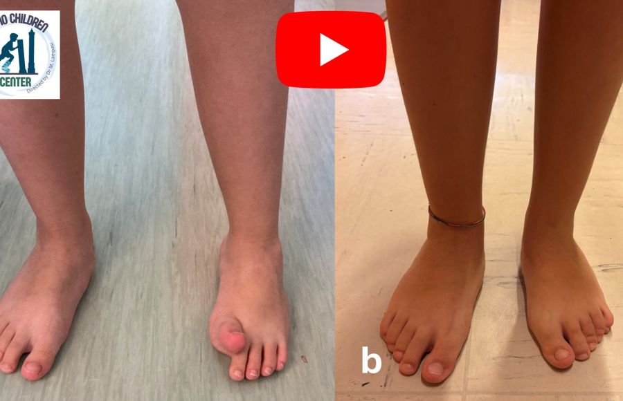 Piede equinovaro in emiparesi (6 anni, Paralisi cerebrale): intervento correttivo