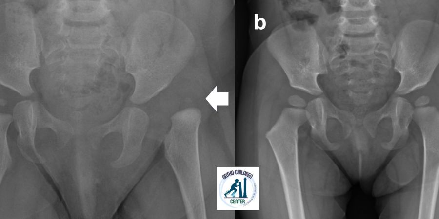 Lussazione congenita dell’anca: presentazione tardiva