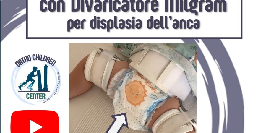 Nuovo tutorial: Come cambiare il pannolino con tutore Milgram per displasia dell’anca