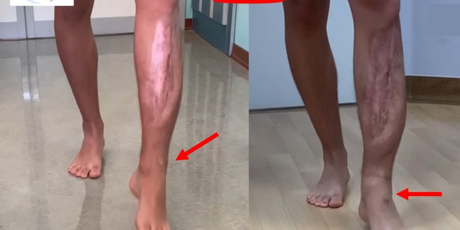 Piede cadente: transfer del tibiale posteriore, 14 anni