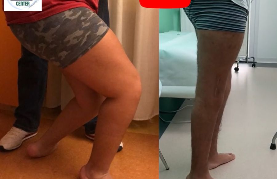 Crouch gait nella Paralisi Cerebrale: intervento multi-level (15 anni)