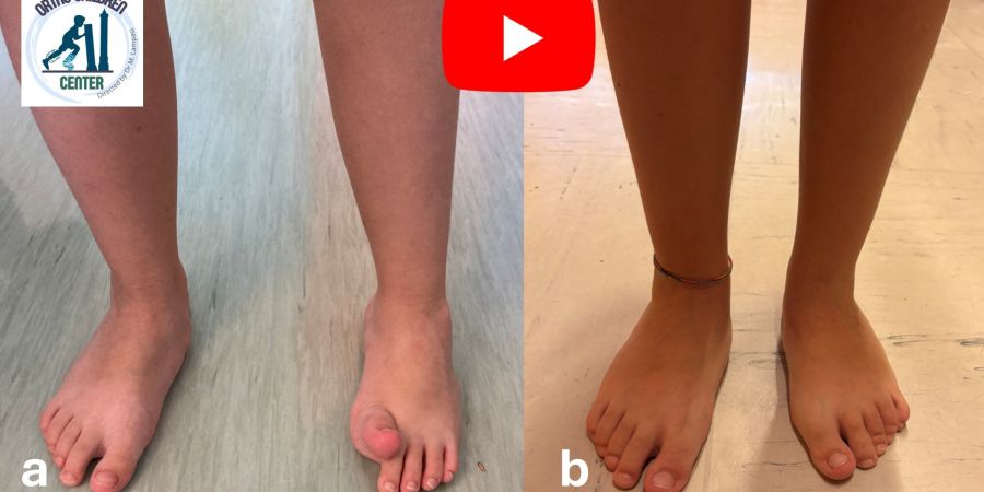 Piede equinovaro in emiparesi (6 anni, Paralisi cerebrale): intervento correttivo