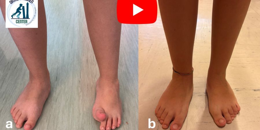 Equinovarus foot in hemiplegia (6 years, Cerebral Palsy): surgical treatment