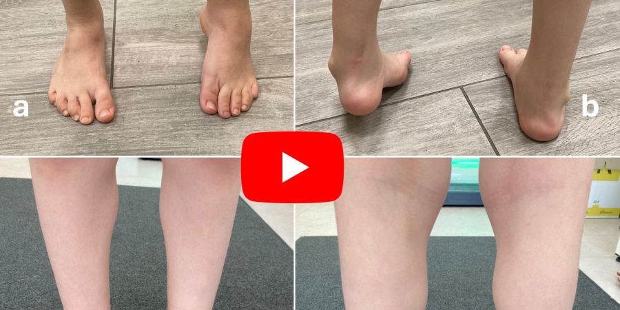 Revision of Tibialis anterior transfer (after previous failure in Switzerland)