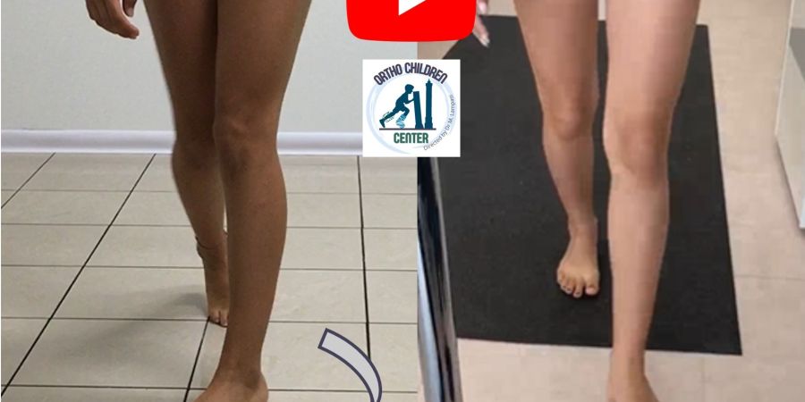 Internal Rotation (severe femoral anteversion): minimally invasive surgery