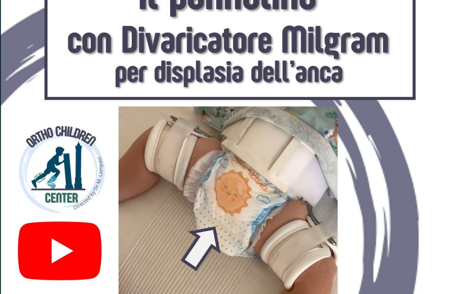 Nuovo tutorial: Come cambiare il pannolino con tutore Milgram per displasia dell’anca