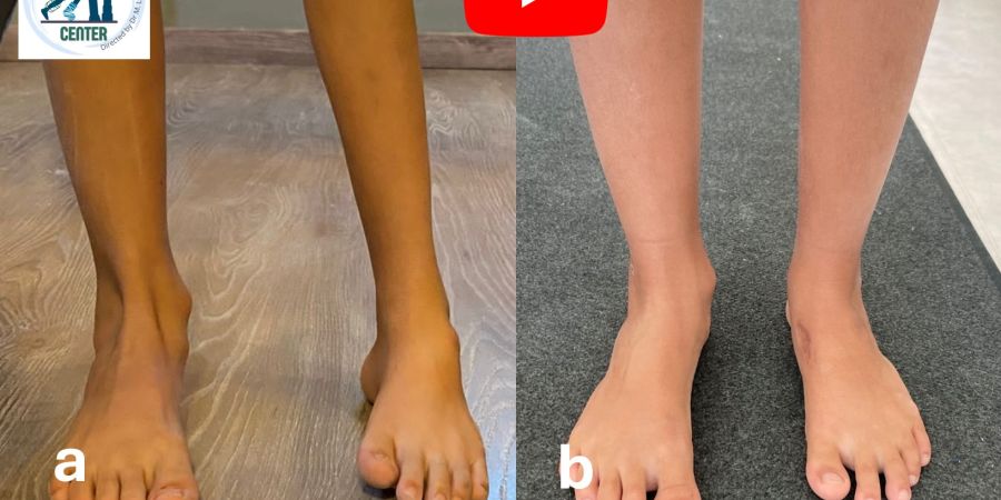 Transfer del Tibiale anteriore per recidiva di piede torto: intervento mini-invasivo e con recupero rapido